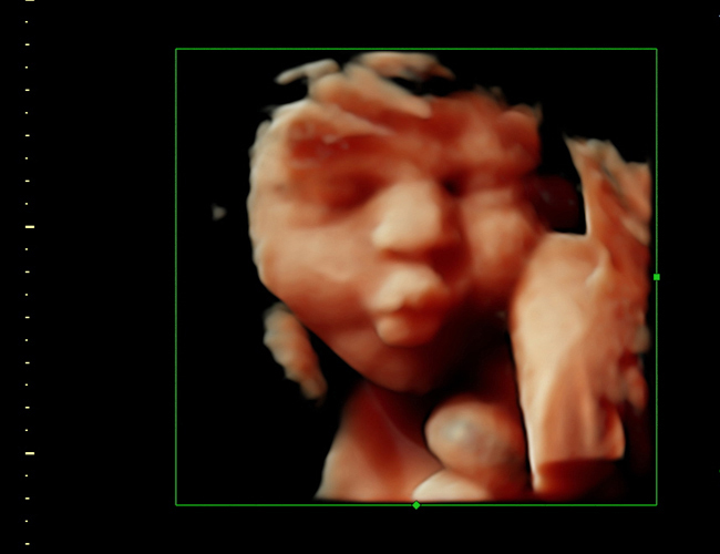 3D ultrasound image at 33 weeks